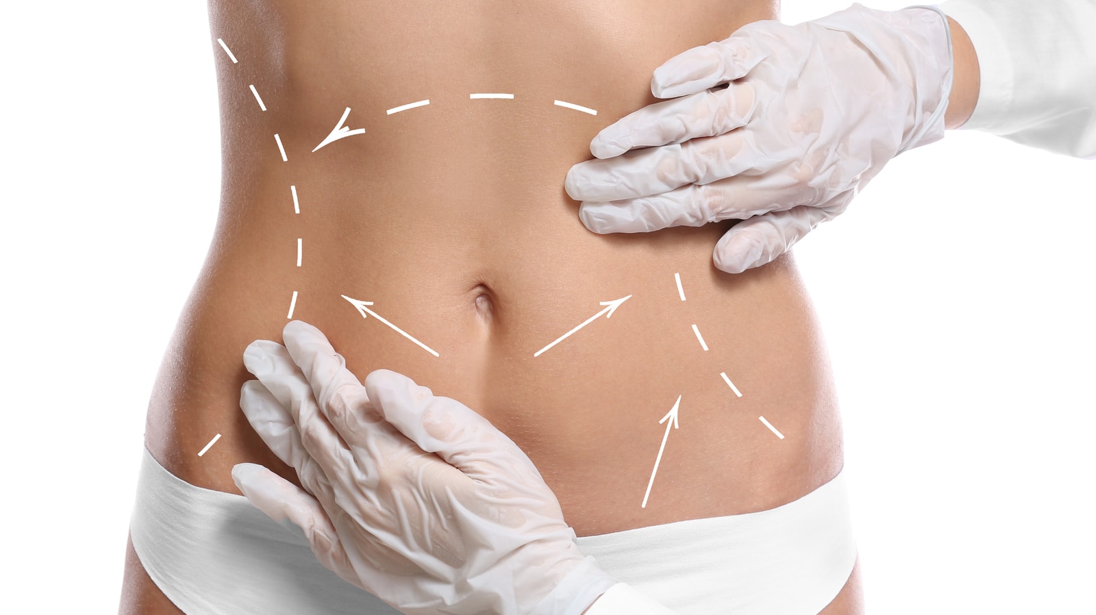 Liposuction